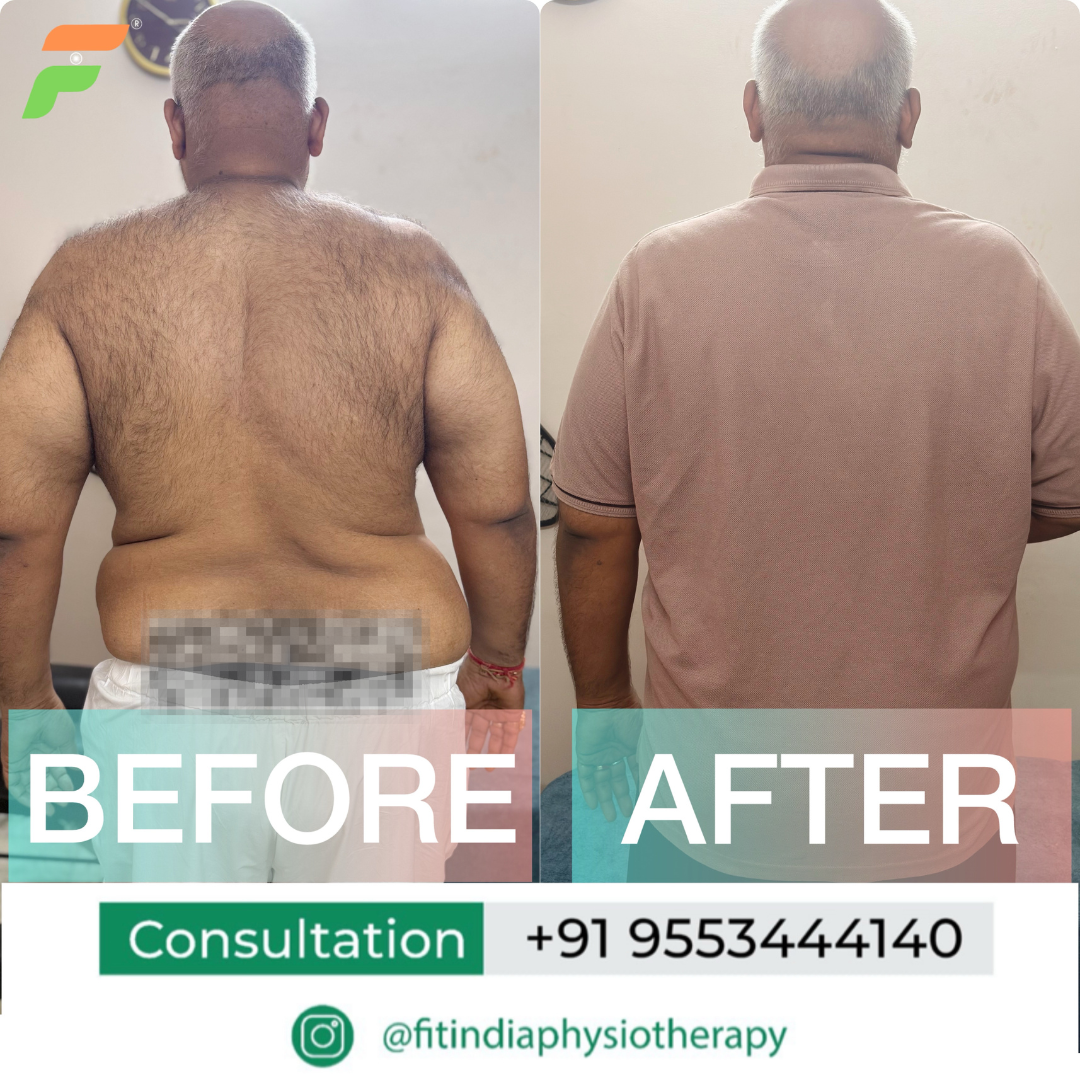 before and after condition of patient after physiotherapy sessions